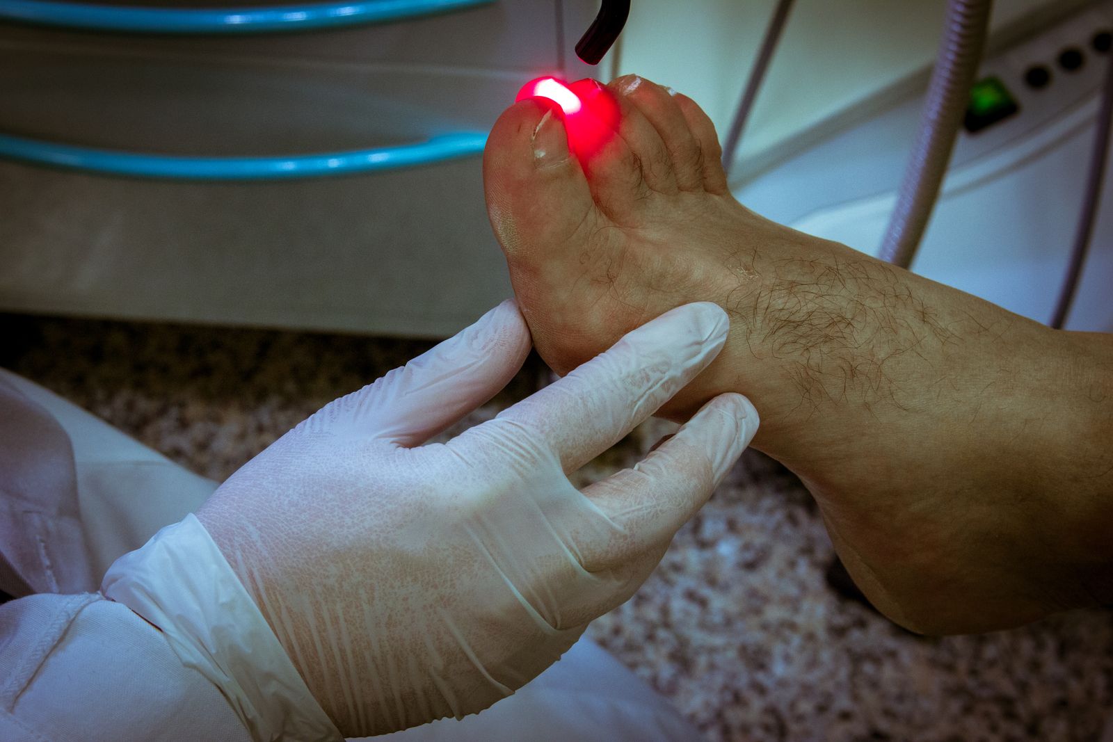 Micosi delle unghie: trattamento nello studio di podologia del Dott. Gonfiantini a Negrar