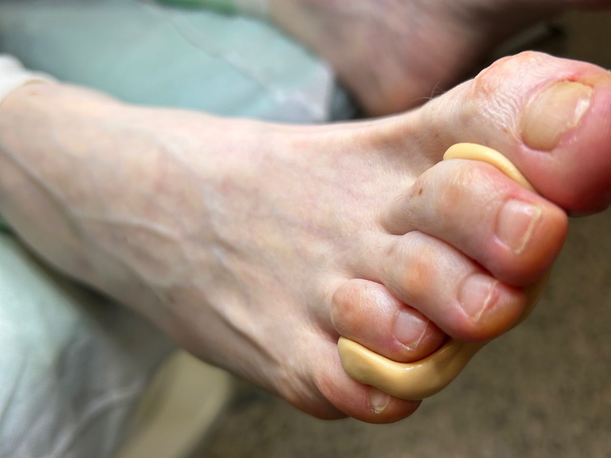 Plantari e ortesi su misura: trattamento nello studio di podologia del Dott. Gonfiantini a Negrar