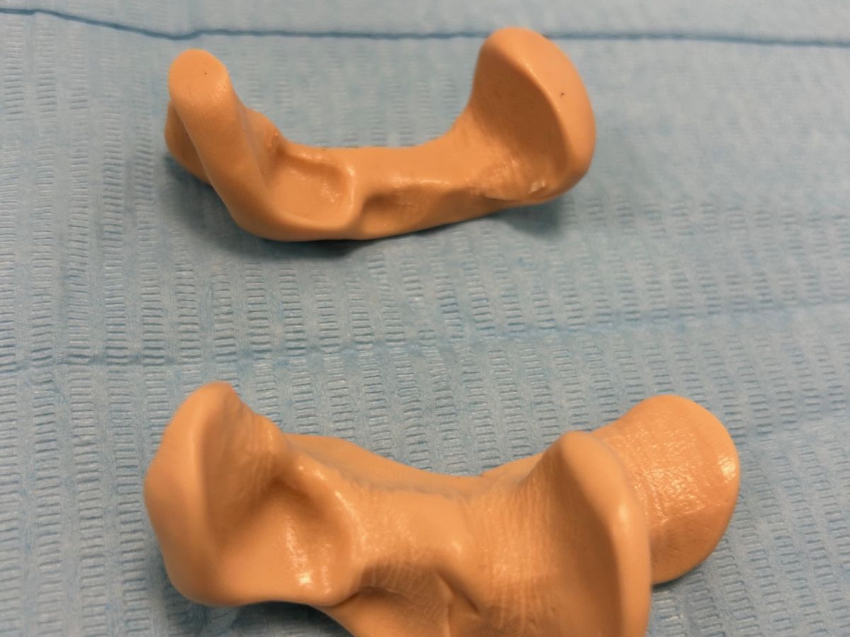 Ortesi digitali in silicone su misura realizzate dal podologo